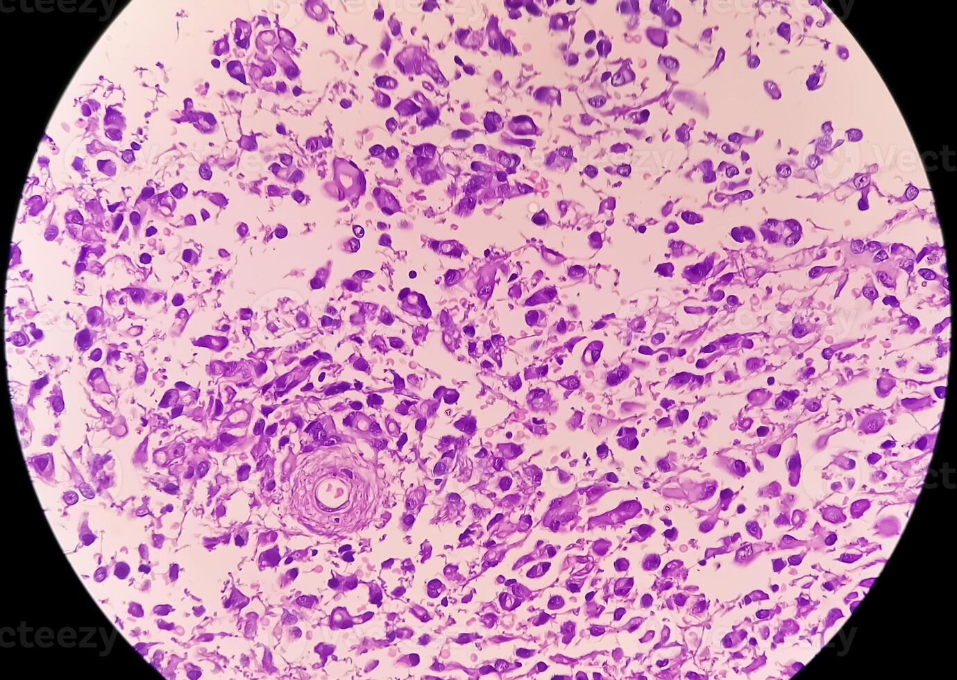 Human meningioma. Meningioma cells are relatively uniform, with a tendency to encircle one another, forming whorls and psammoma bodies, concentric laminated eosinophilic bodies that tend to calcify photo