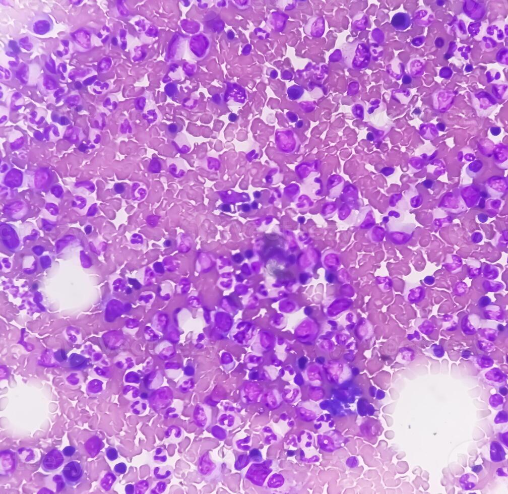 Photomicrograph Bone marrow study, Megakaryocytic Hyperplasia photo