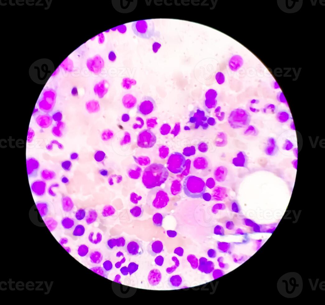 Photomicrograph Bone marrow study, Megakaryocytic Hyperplasia photo