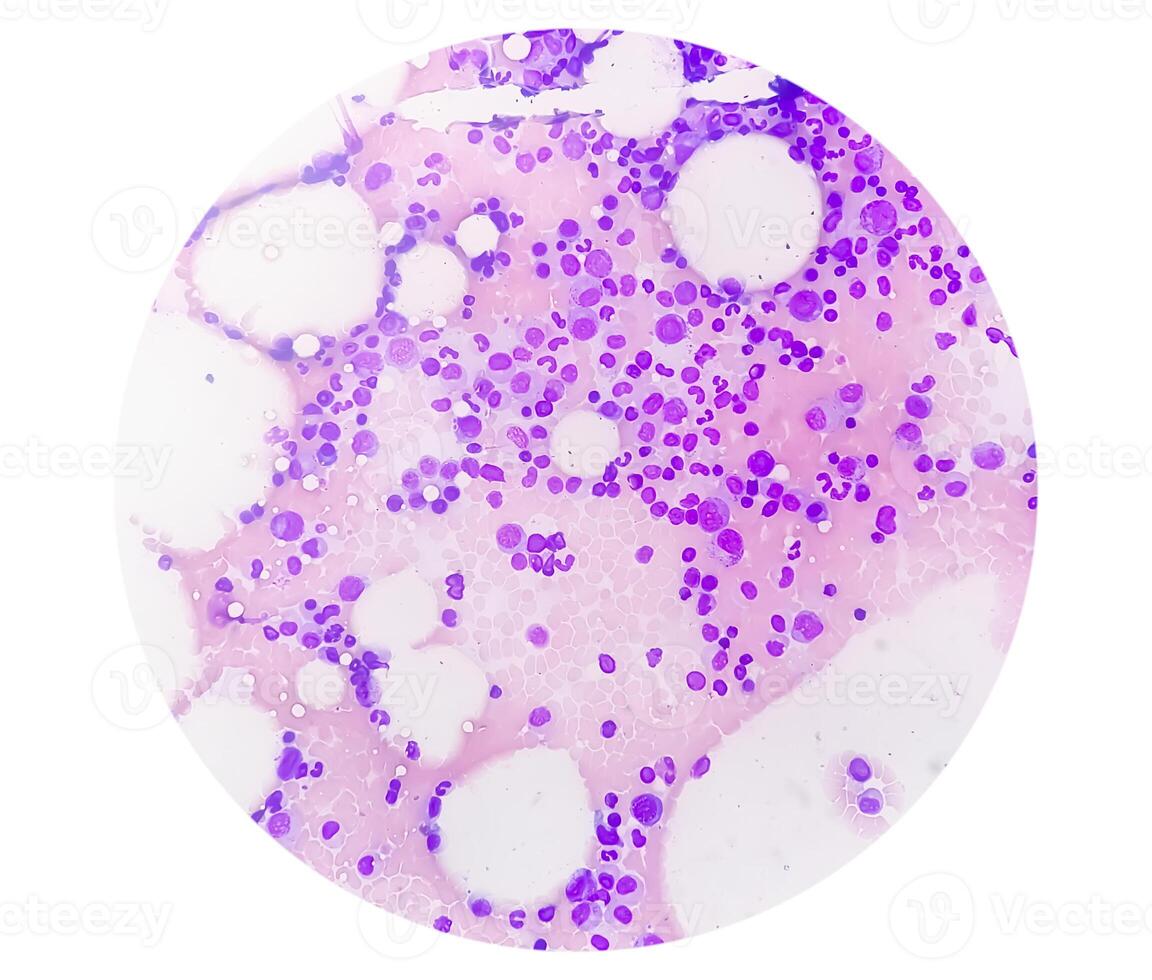 Photomicrograph Bone marrow study, Megakaryocytic Hyperplasia photo