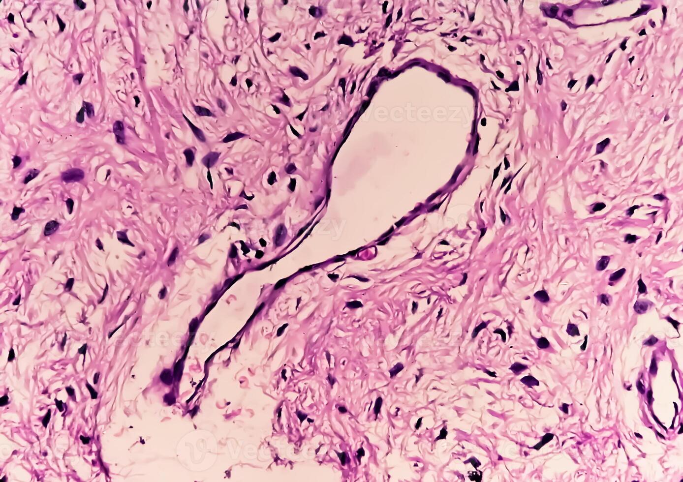 Leg tissue biopsy, Photomicrographic image showing Fibromyxoma. Superficial Acral Fibromyxoma, rare slow growing myxoid tumor photo