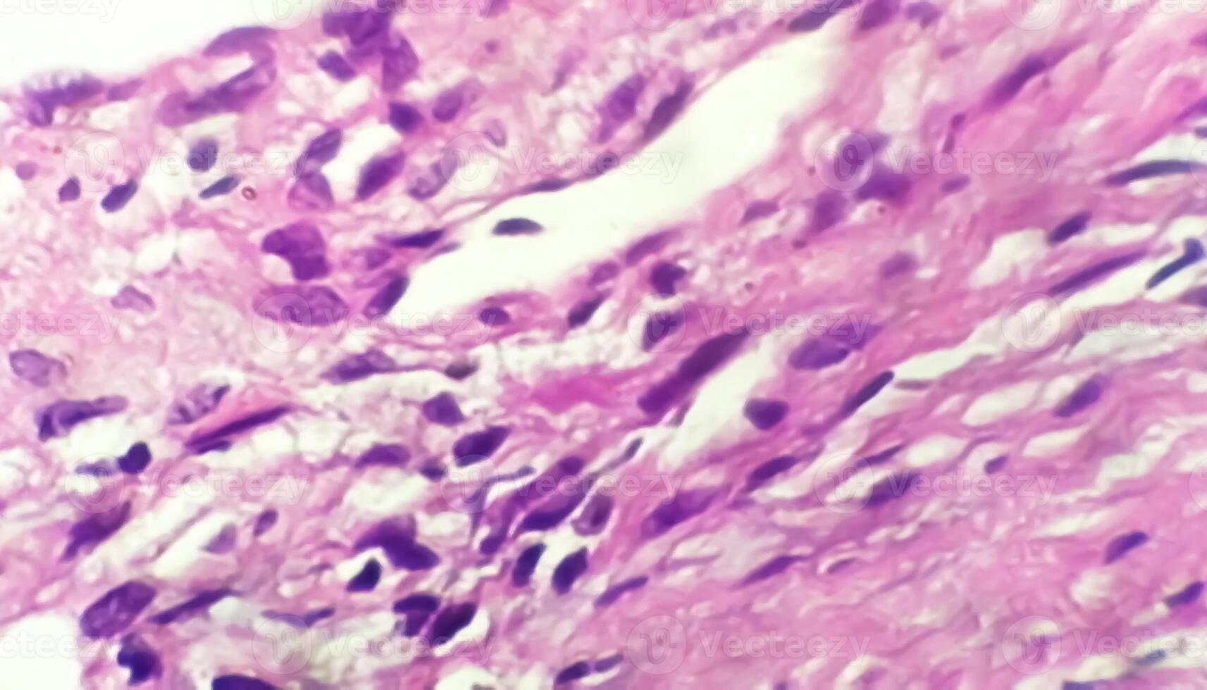Photomicrograph of histological slide showing Lobular capillary hemangioma on finger. photo