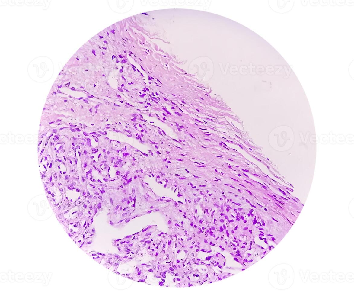 Histopathological photomicrograph of ovarian cyst showing Metastatic cystic teratoma. photo