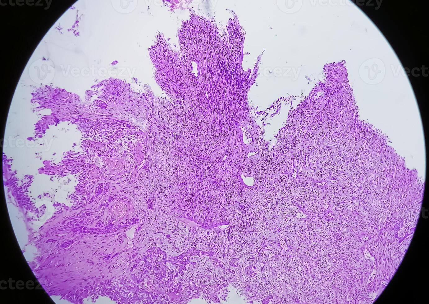 Histology, Peritoneal inclusion cyst. Paraovarian cysts, hydrosalpinx and low-grade cystic mesothelioma are usually considered in the differential diagnosis of PICs. photo