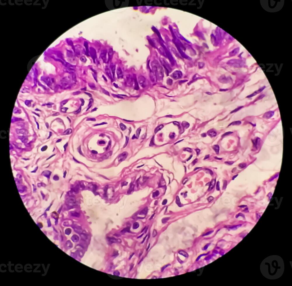 Histology, Peritoneal inclusion cyst. Paraovarian cysts, hydrosalpinx and low-grade cystic mesothelioma are usually considered in the differential diagnosis of PICs. photo