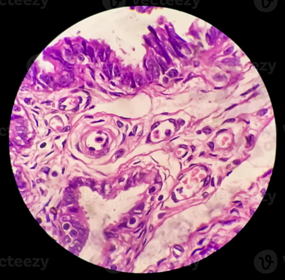 histología, peritoneal inclusión quiste. paraovárico quistes, hidrosálpinx y grado bajo cístico mesotelioma son por lo general considerado en el diferencial diagnóstico de fotos. foto