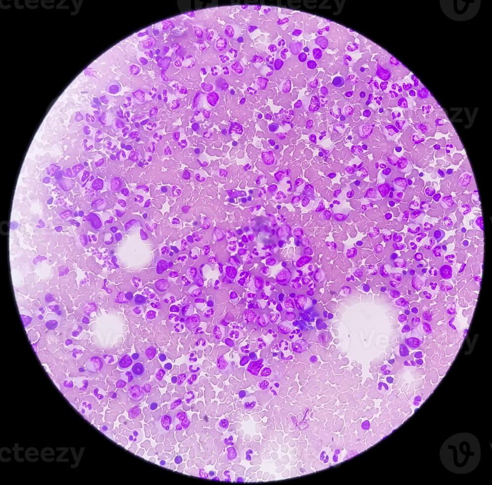 Photomicrograph Bone marrow study, Megakaryocytic Hyperplasia photo