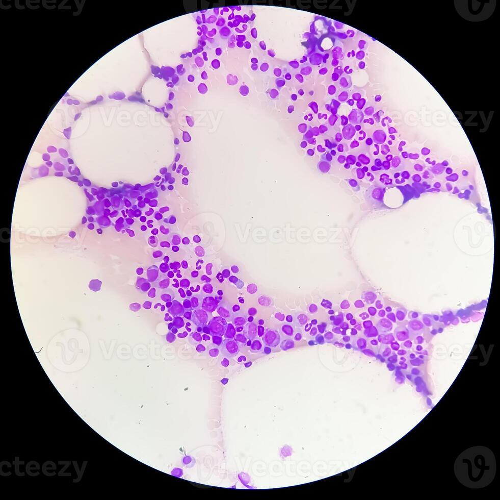 Photomicrograph Bone marrow study, Megakaryocytic Hyperplasia photo