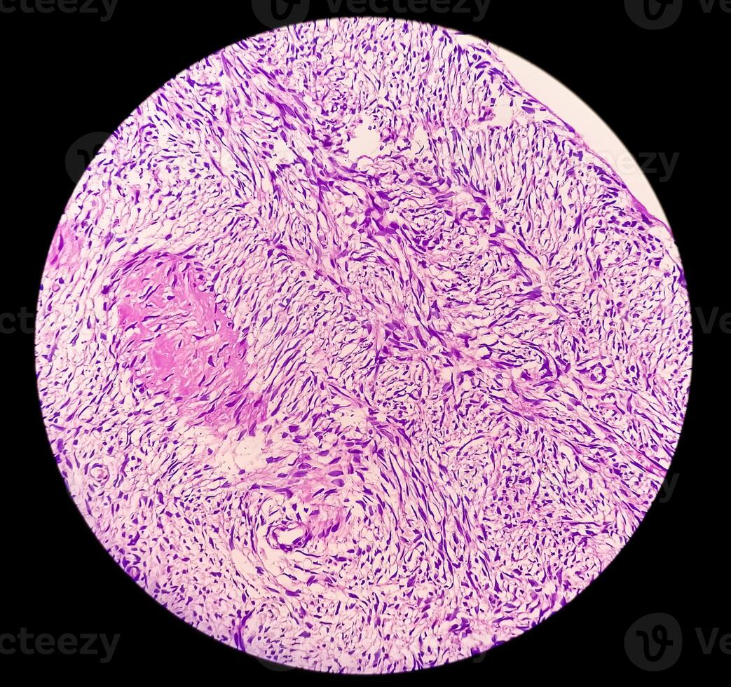 pierna pañuelo de papel biopsia. fotomicrográfico imagen demostración fibromixoma. superficial acral fibromixoma, raro lento creciente mixoide tumor. foto