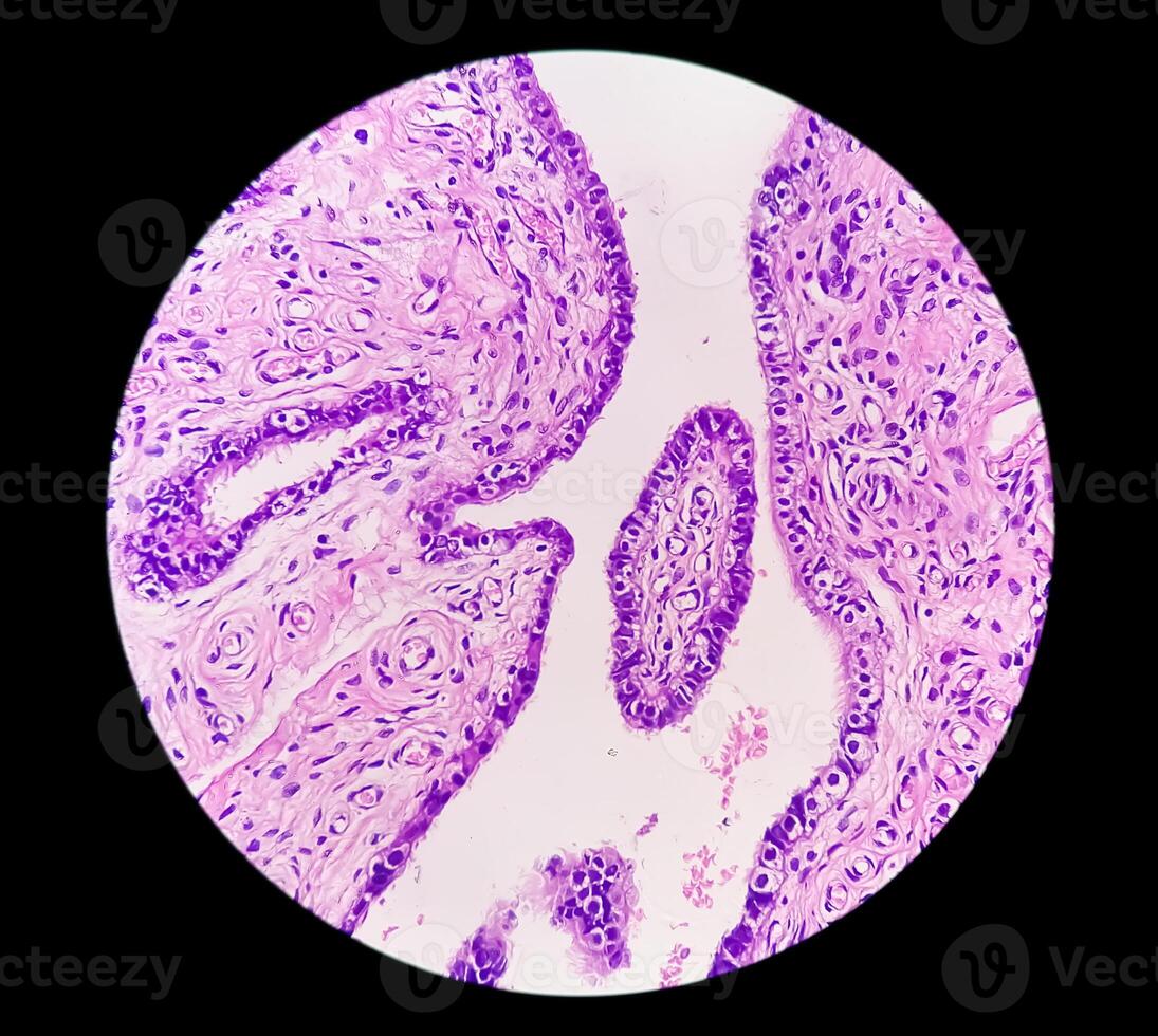 Histopathological photomicrograph of ovarian cyst showing Metastatic cystic teratoma. photo