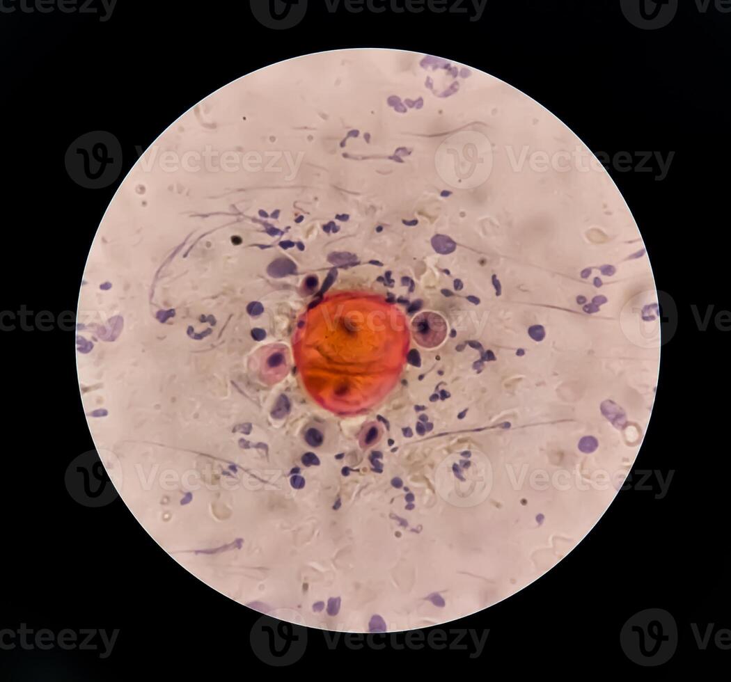 Photomicrograph of Paps Smear. Inflammatory smear with vaginal candidiasis . Medical concept photo