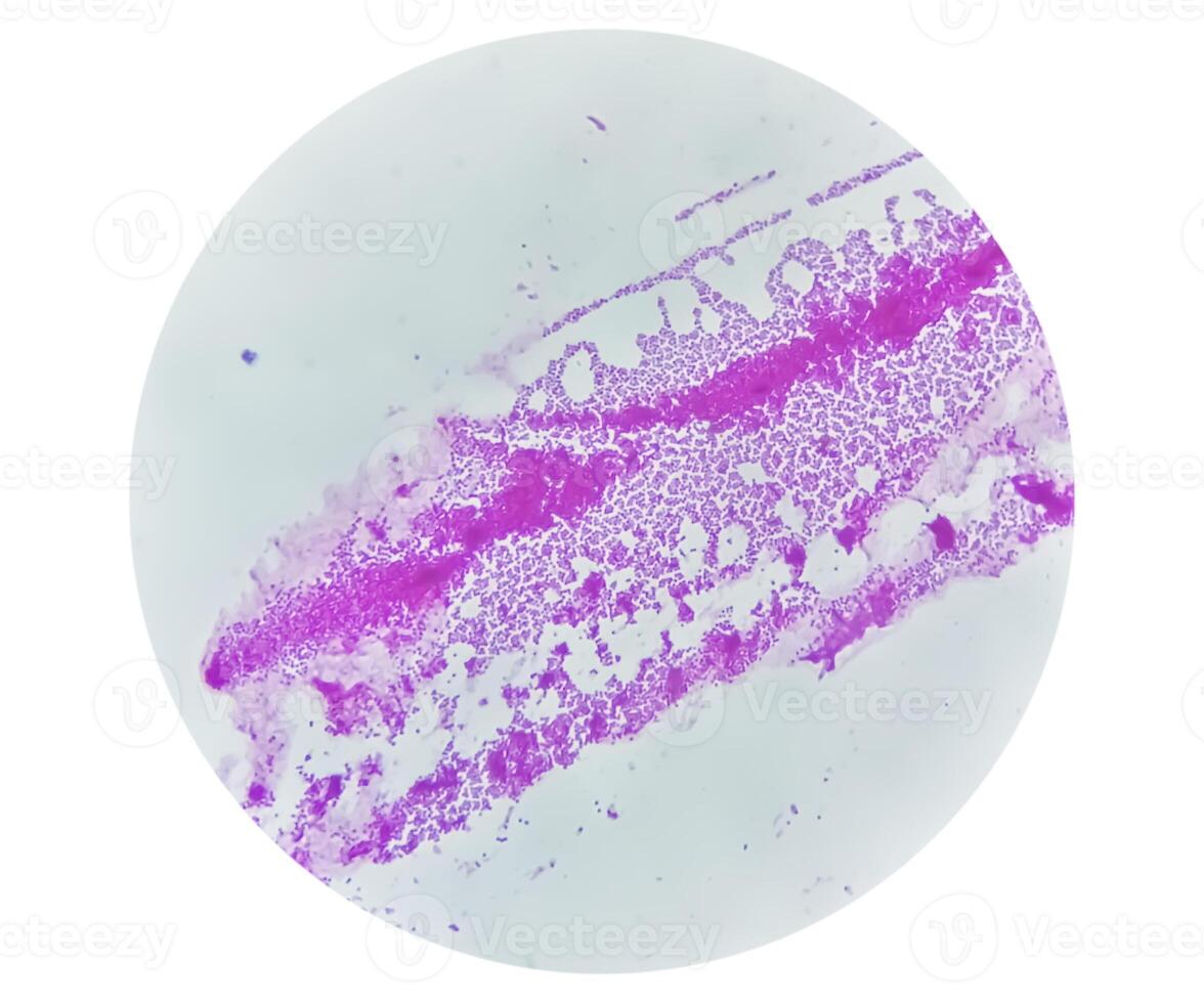 Pus gram stained microscopic showing gram positive bacteria. photo
