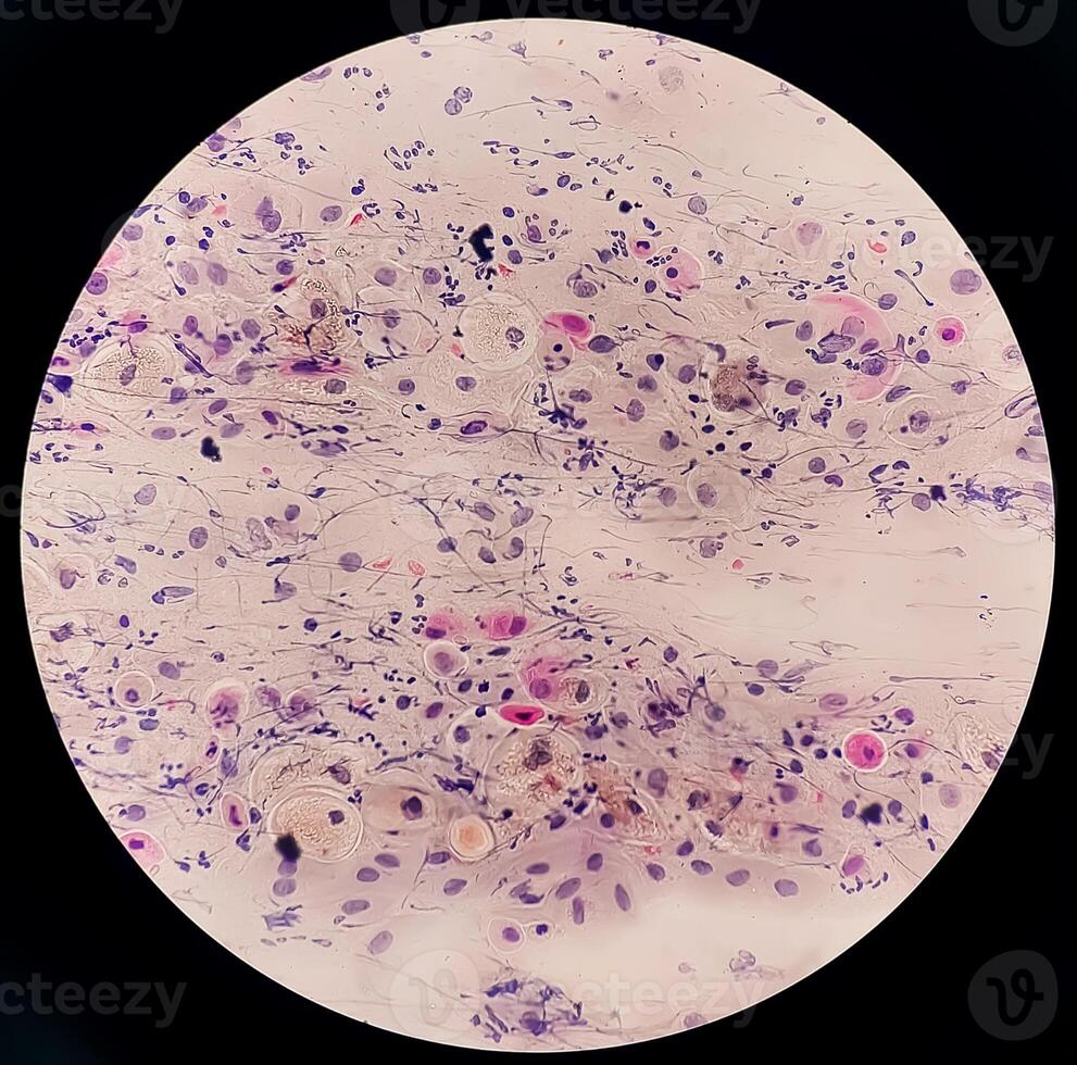 Photomicrograph of Paps Smear. Inflammatory smear with vaginal candidiasis . Medical concept photo