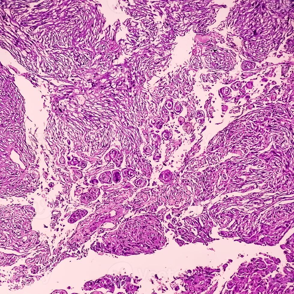 Histology, Peritoneal inclusion cyst. Paraovarian cysts, hydrosalpinx and low-grade cystic mesothelioma are usually considered in the differential diagnosis of PICs. photo