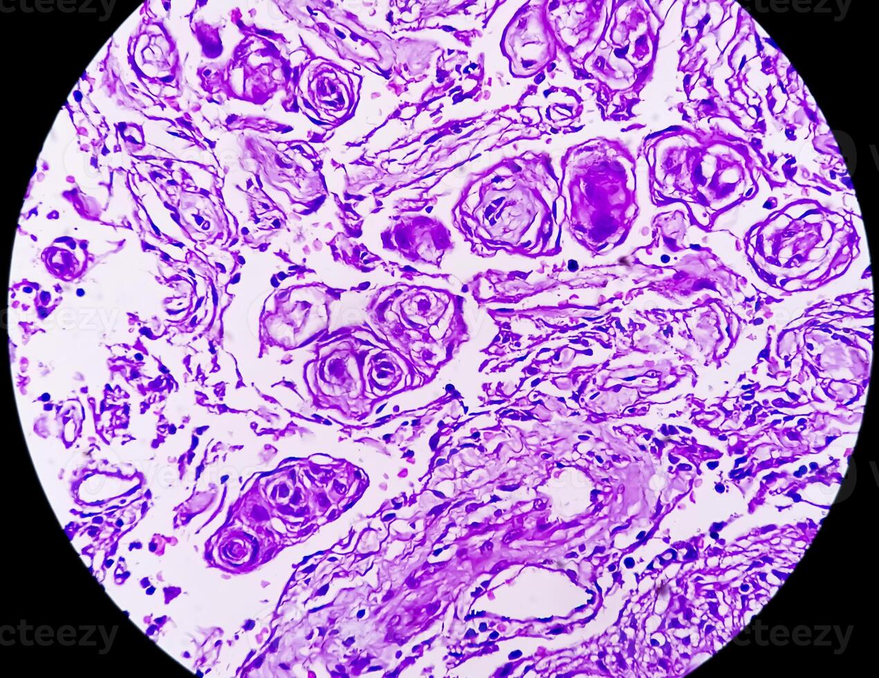 Histology, Peritoneal inclusion cyst. Paraovarian cysts, hydrosalpinx and low-grade cystic mesothelioma are usually considered in the differential diagnosis of PICs. photo