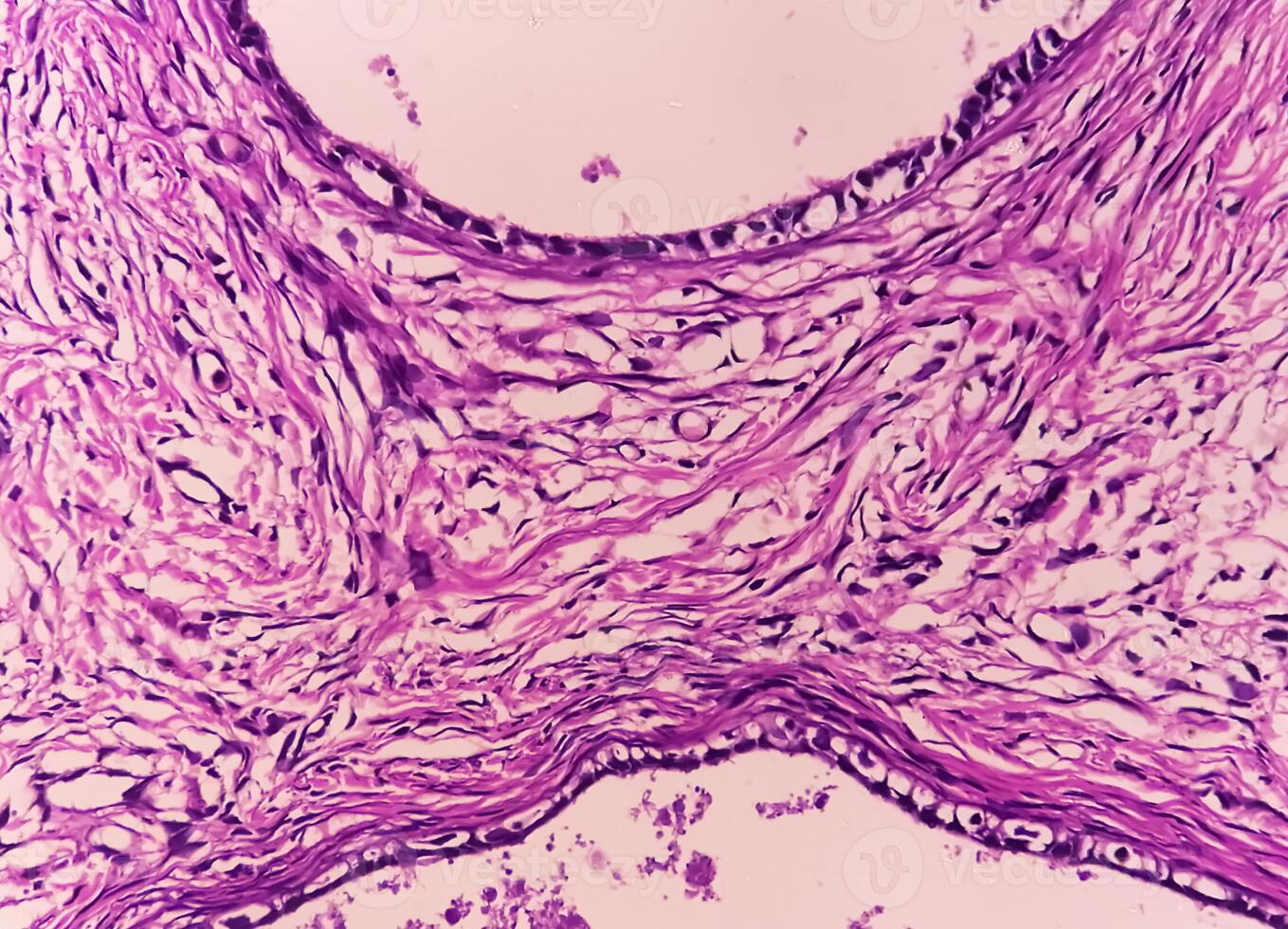 Histology, Peritoneal inclusion cyst. Paraovarian cysts, hydrosalpinx and low-grade cystic mesothelioma are usually considered in the differential diagnosis of PICs. photo