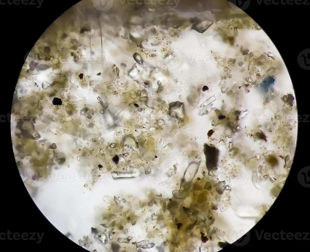 Schistosoma Parasite ova in human urine specimen under microscope. Urinary parasite photo