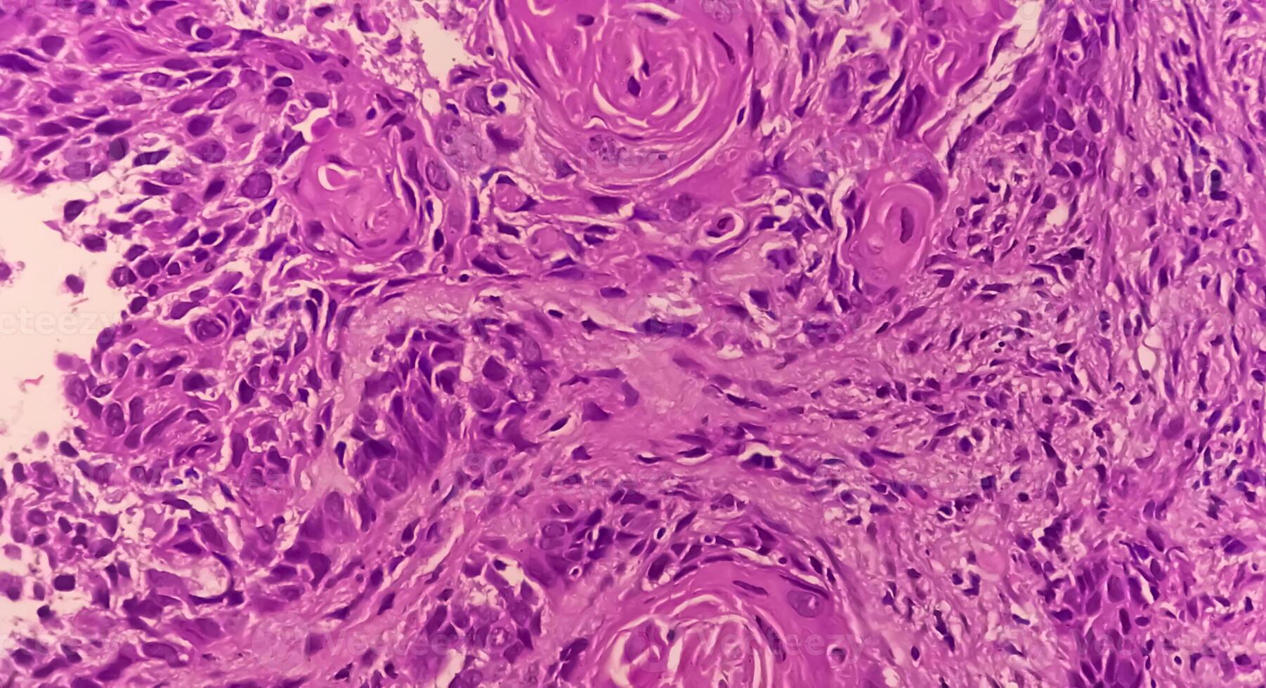 Photomicrograph of histological slide showing Lobular capillary hemangioma on finger. photo