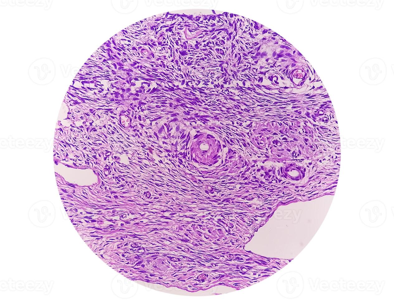 Photomicrograph of histological slide showing Lobular capillary hemangioma on finger. photo