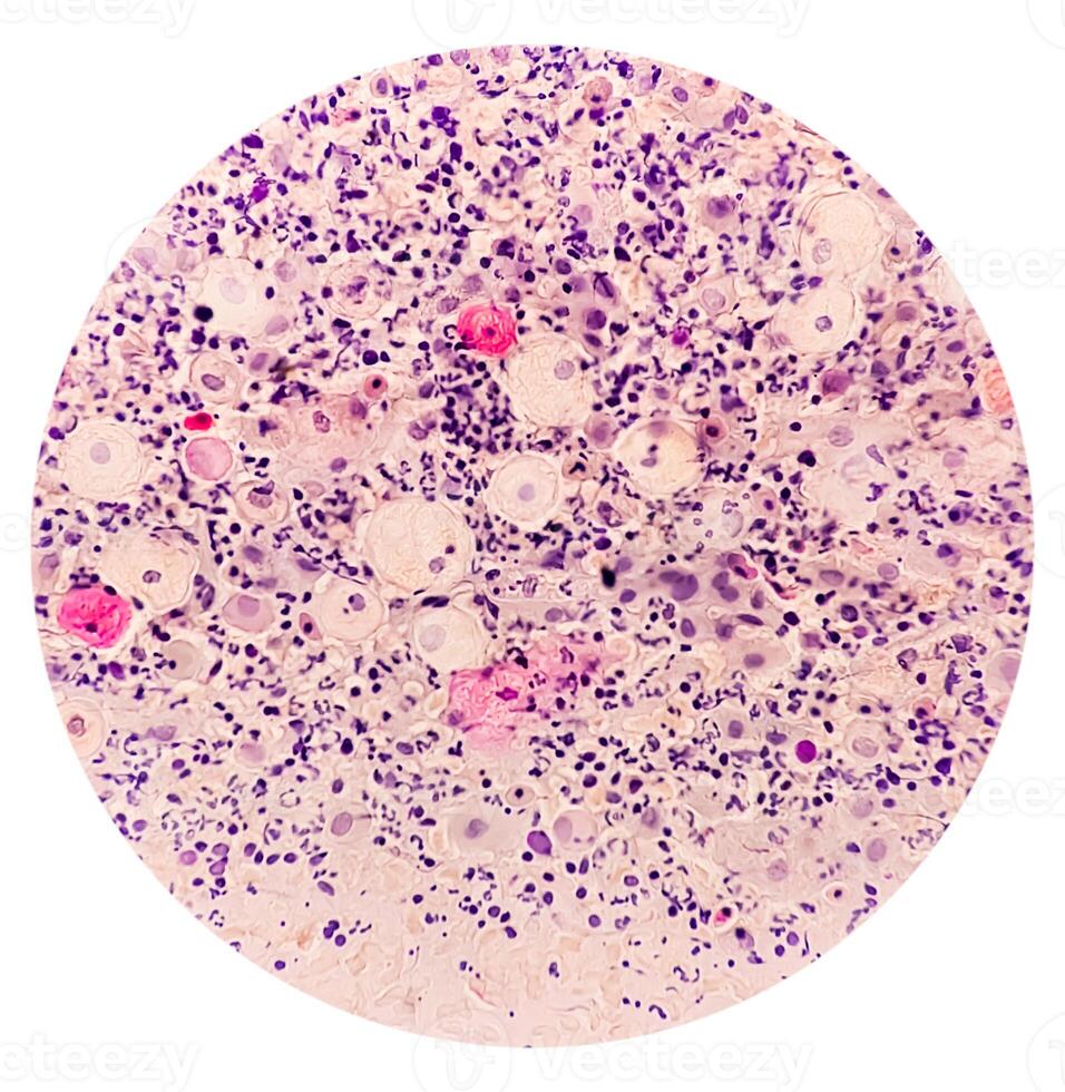 Photomicrograph of Paps Smear. Inflammatory smear with vaginal candidiasis . Medical concept photo