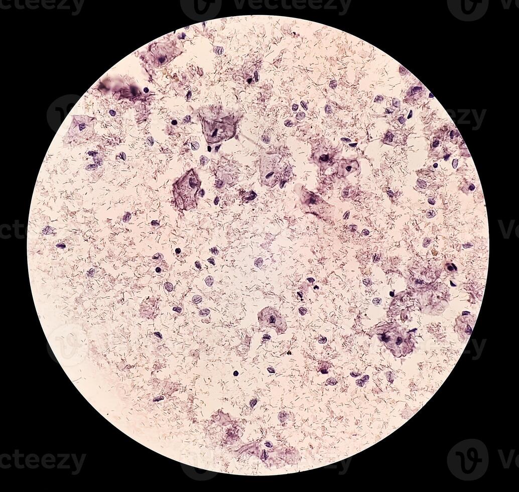 Trichomonas vaginalis is an anaerobic, flagellated protozoan parasite and the causative agent of trichomoniasis. photo