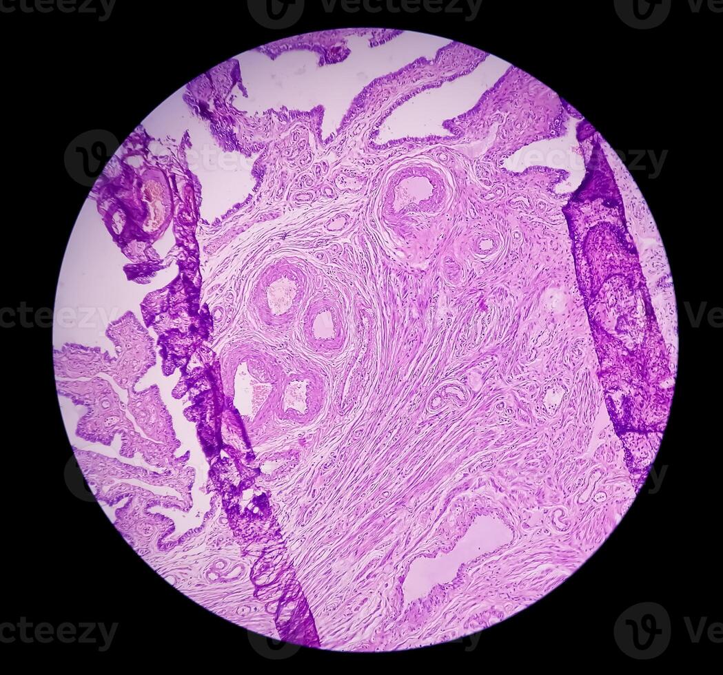 histología, peritoneal inclusión quiste. paraovárico quistes, hidrosálpinx y grado bajo cístico mesotelioma son por lo general considerado en el diferencial diagnóstico de fotos. foto