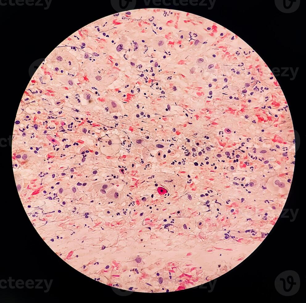 Photomicrograph of Paps Smear. Inflammatory smear with vaginal candidiasis . Medical concept photo