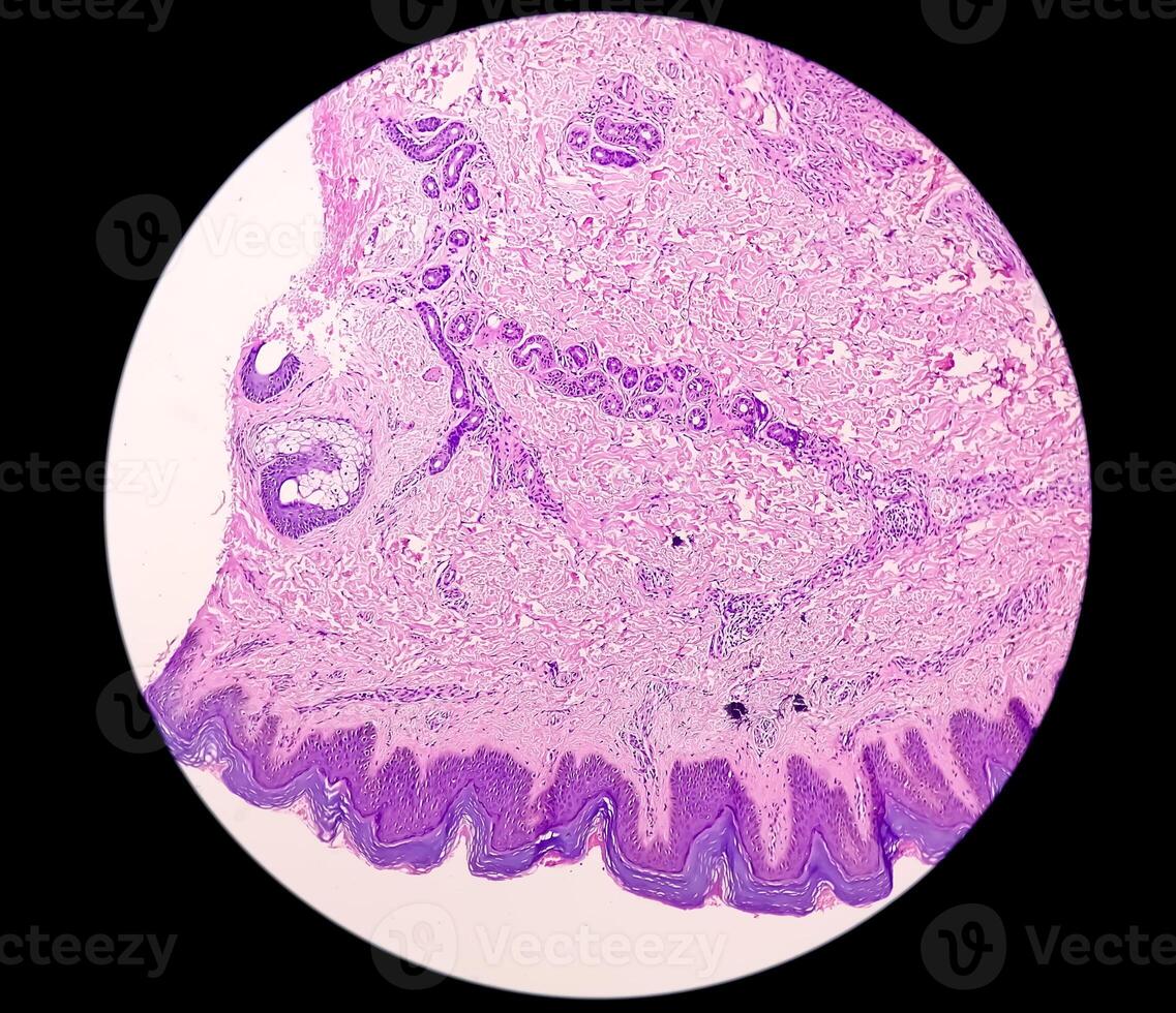 Histological Photomicrograph. Prurigo nodularis or PN is a chronic disorder of the skin. photo