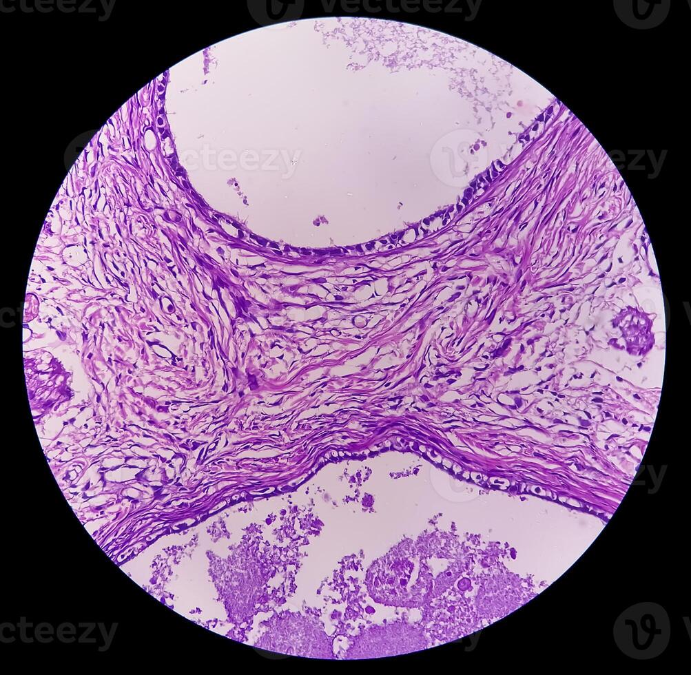 Histological Photomicrograph. Prurigo nodularis or PN is a chronic disorder of the skin. photo