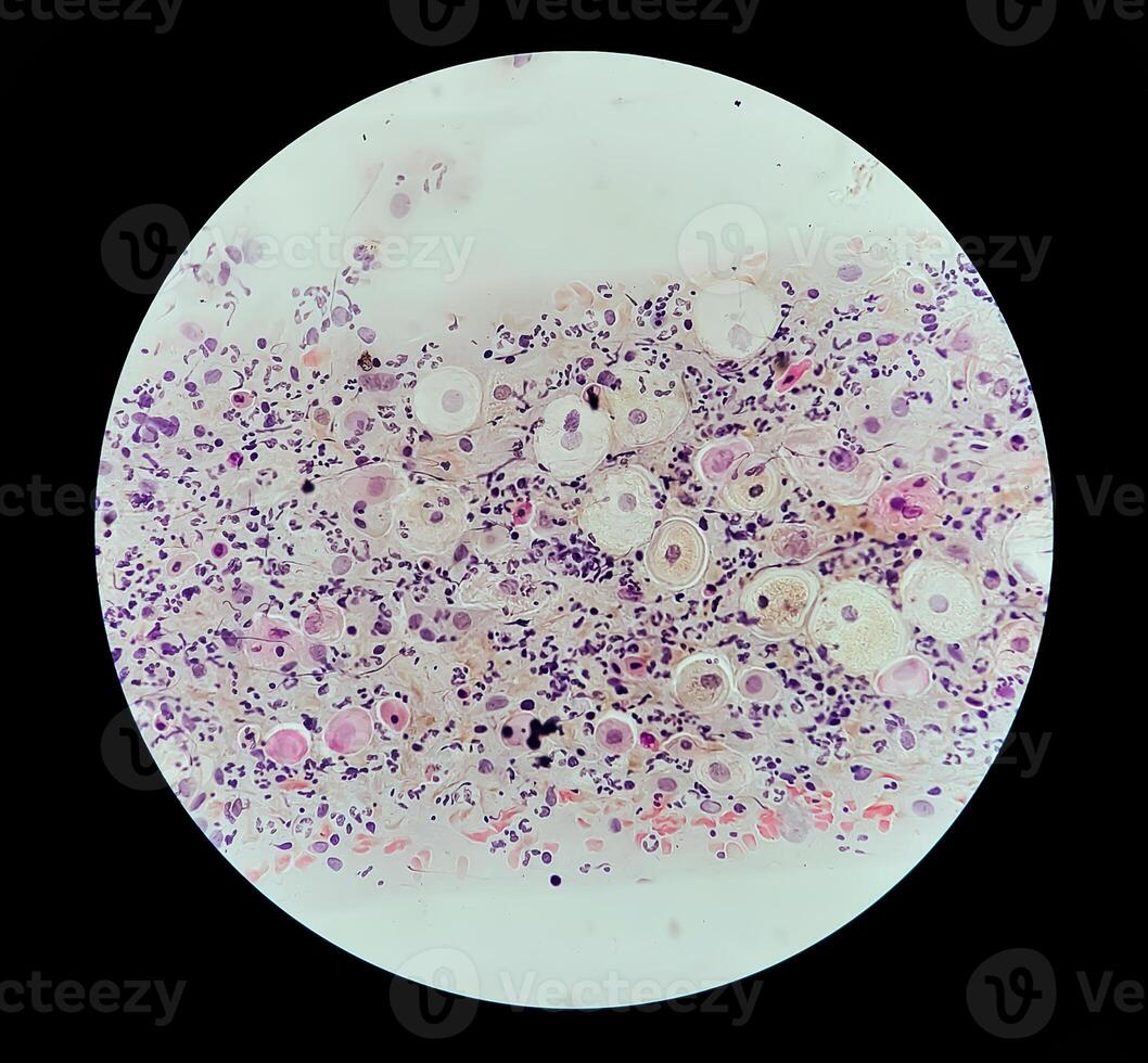 Photomicrograph of Paps Smear. Inflammatory smear with vaginal candidiasis . Medical concept. photo