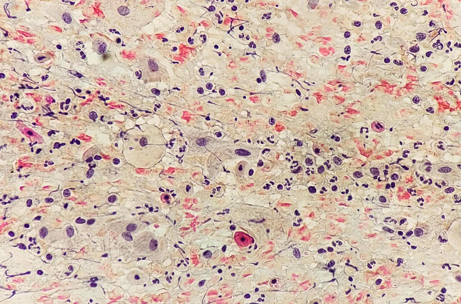 Photomicrograph of Paps Smear. Inflammatory smear with vaginal candidiasis . Medical concept photo
