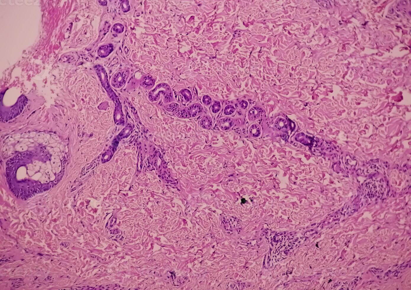 Histological Photomicrograph. Prurigo nodularis or PN is a chronic disorder of the skin. photo