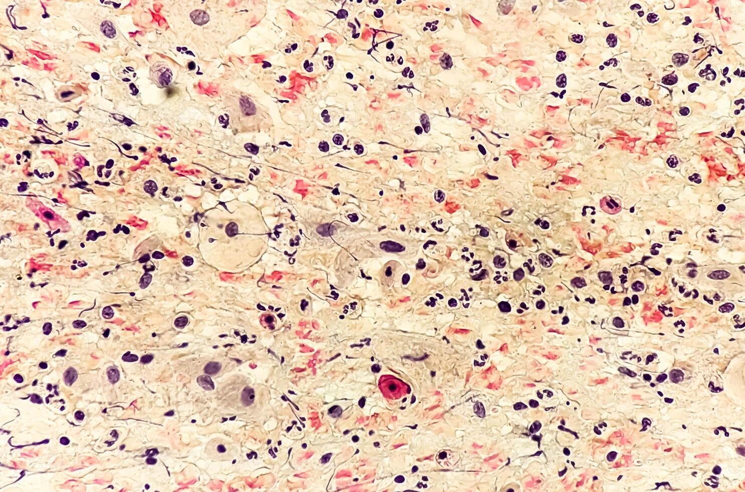 Photomicrograph of Paps Smear. Inflammatory smear with vaginal candidiasis . Medical concept photo