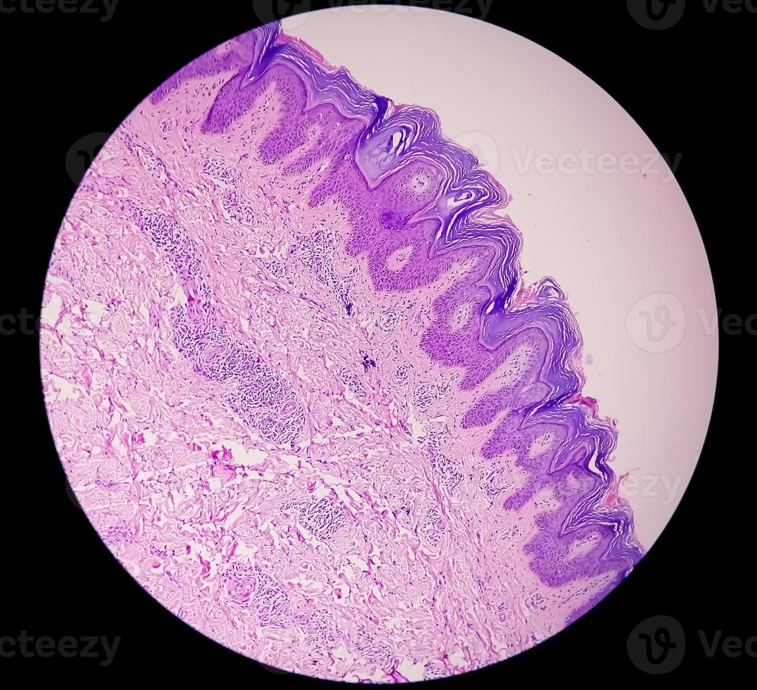 Histological Photomicrograph. Prurigo nodularis or PN is a chronic disorder of the skin. photo