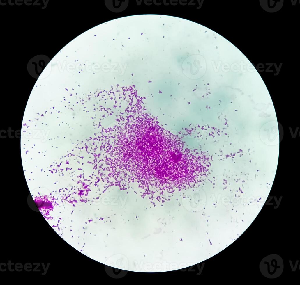 Pus gram stained microscopic showing gram positive bacteria. photo