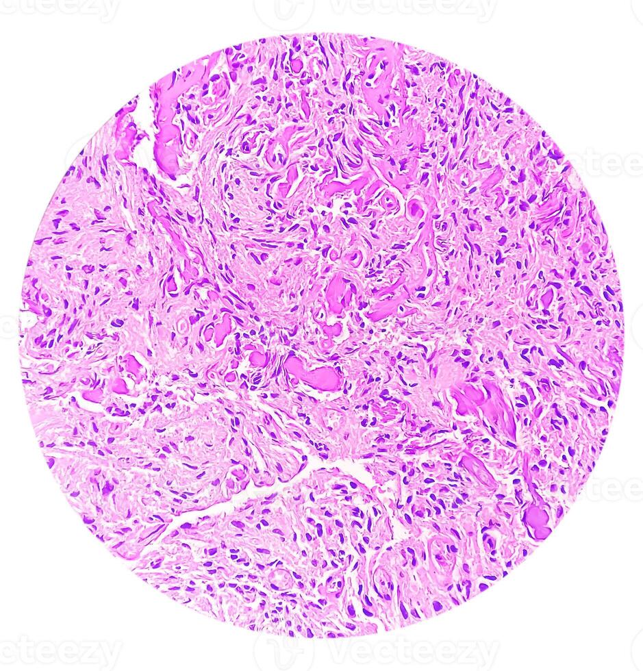 Photomicrograph of histological slide showing Lobular capillary hemangioma on finger. photo