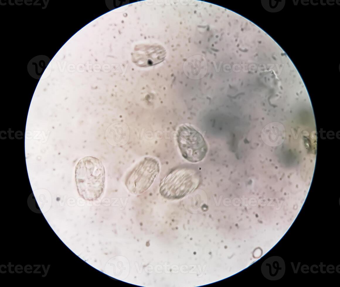 Schistosoma Parasite ova in human urine specimen under microscope. Urinary parasite photo