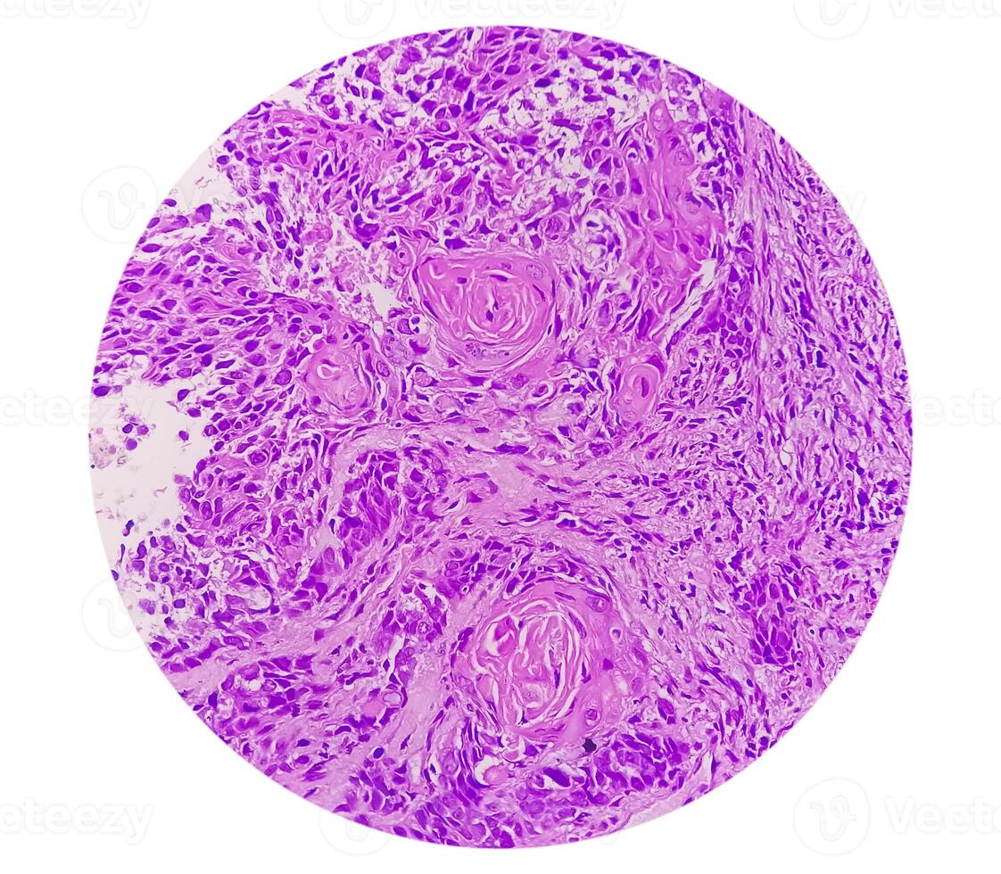 Histology, Peritoneal inclusion cyst. Paraovarian cysts, hydrosalpinx and low-grade cystic mesothelioma are usually considered in the differential diagnosis of PICs. photo