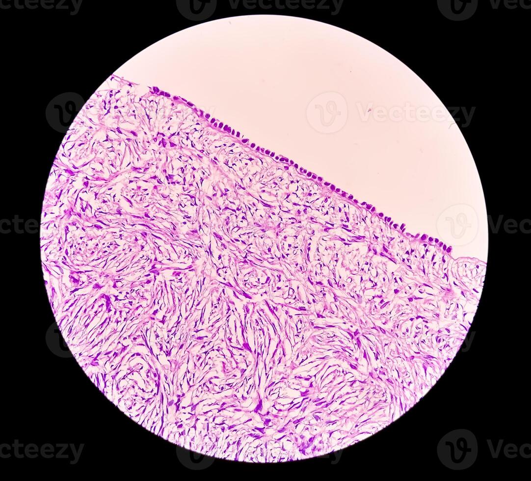 Leg tissue biopsy. Photomicrographic image showing Fibromyxoma. Superficial Acral Fibromyxoma, rare slow growing myxoid tumor. photo
