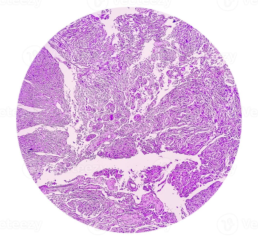 Histology, Peritoneal inclusion cyst. Paraovarian cysts, hydrosalpinx and low-grade cystic mesothelioma are usually considered in the differential diagnosis of PICs. photo