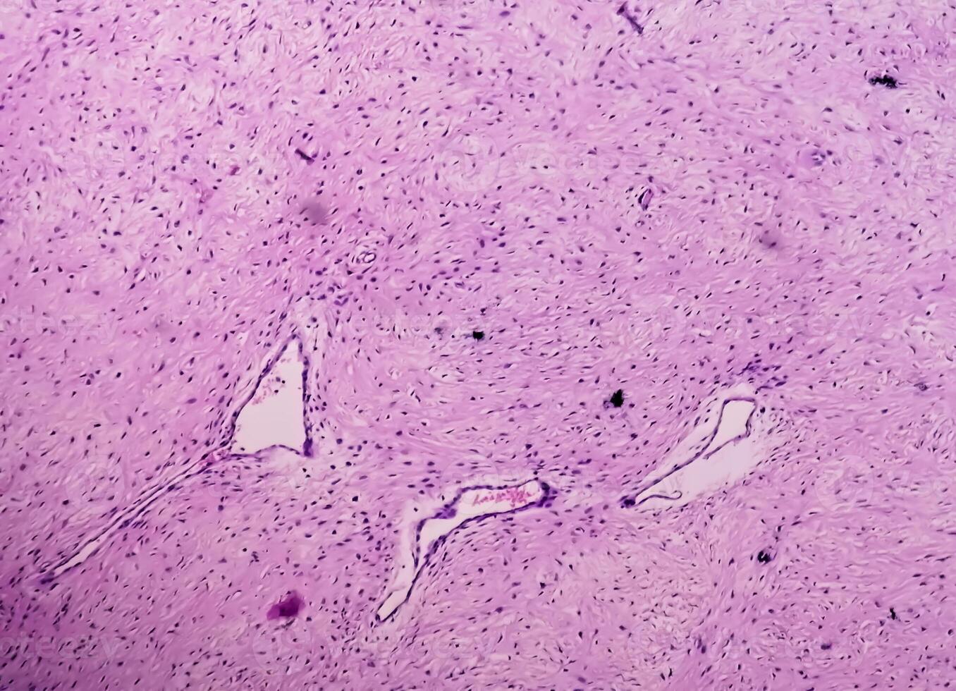 Leg tissue biopsy. Photomicrographic image showing Fibromyxoma. Superficial Acral Fibromyxoma, rare slow growing myxoid tumor. photo