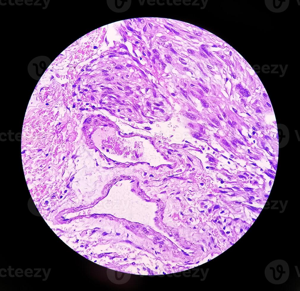 Photomicrograph of histological slide showing Lobular capillary hemangioma on finger. photo