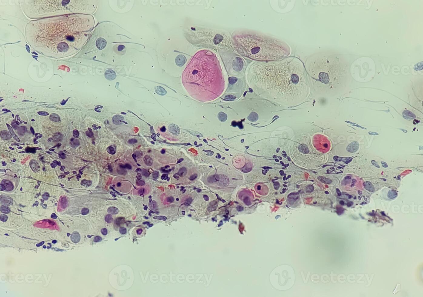 Photomicrograph of Paps Smear. Inflammatory smear with vaginal candidiasis . Medical concept photo