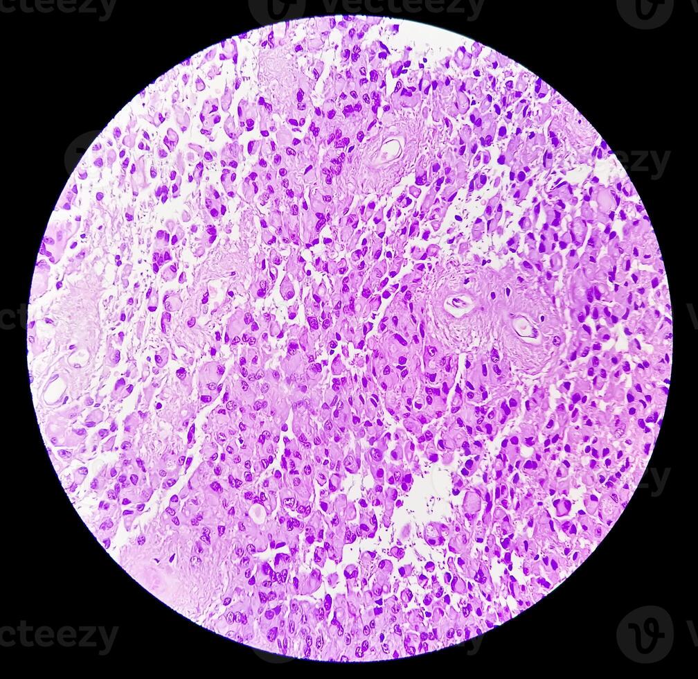 Photomicrograph of histological slide showing Lobular capillary hemangioma on finger. photo