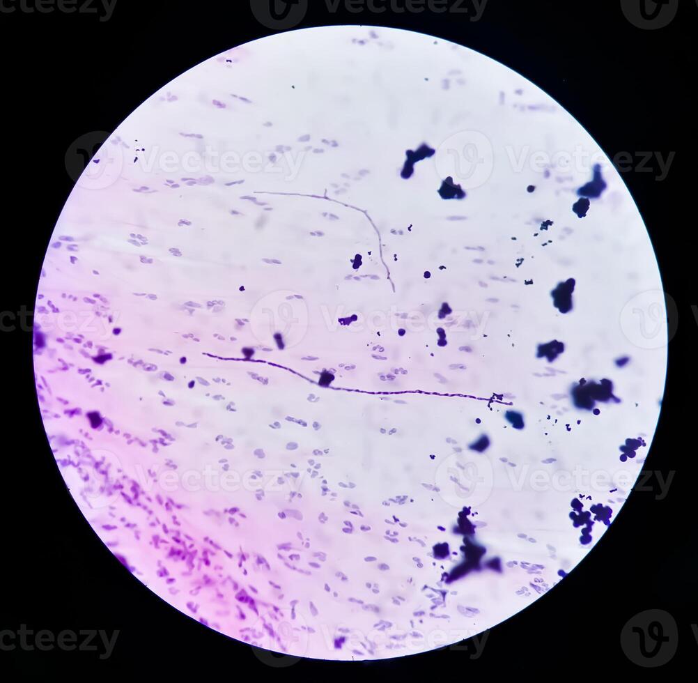 microfotografía de paparazzi frotis. inflamatorio frotis con vaginal candidiasis . médico concepto. foto