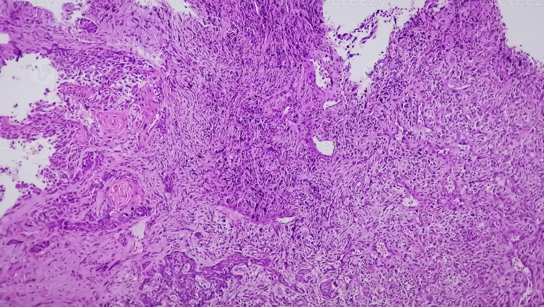 Photomicrograph of histological slide showing Lobular capillary hemangioma on finger. photo