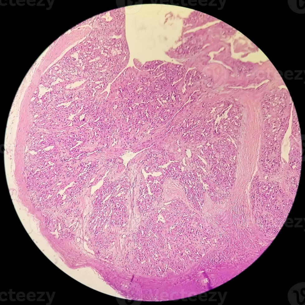 Histology, Peritoneal inclusion cyst. Paraovarian cysts, hydrosalpinx and low-grade cystic mesothelioma are usually considered in the differential diagnosis of PICs. photo