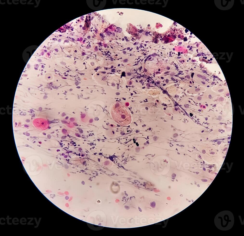 microfotografía de paparazzi frotis. inflamatorio frotis con vaginal candidiasis . médico concepto foto