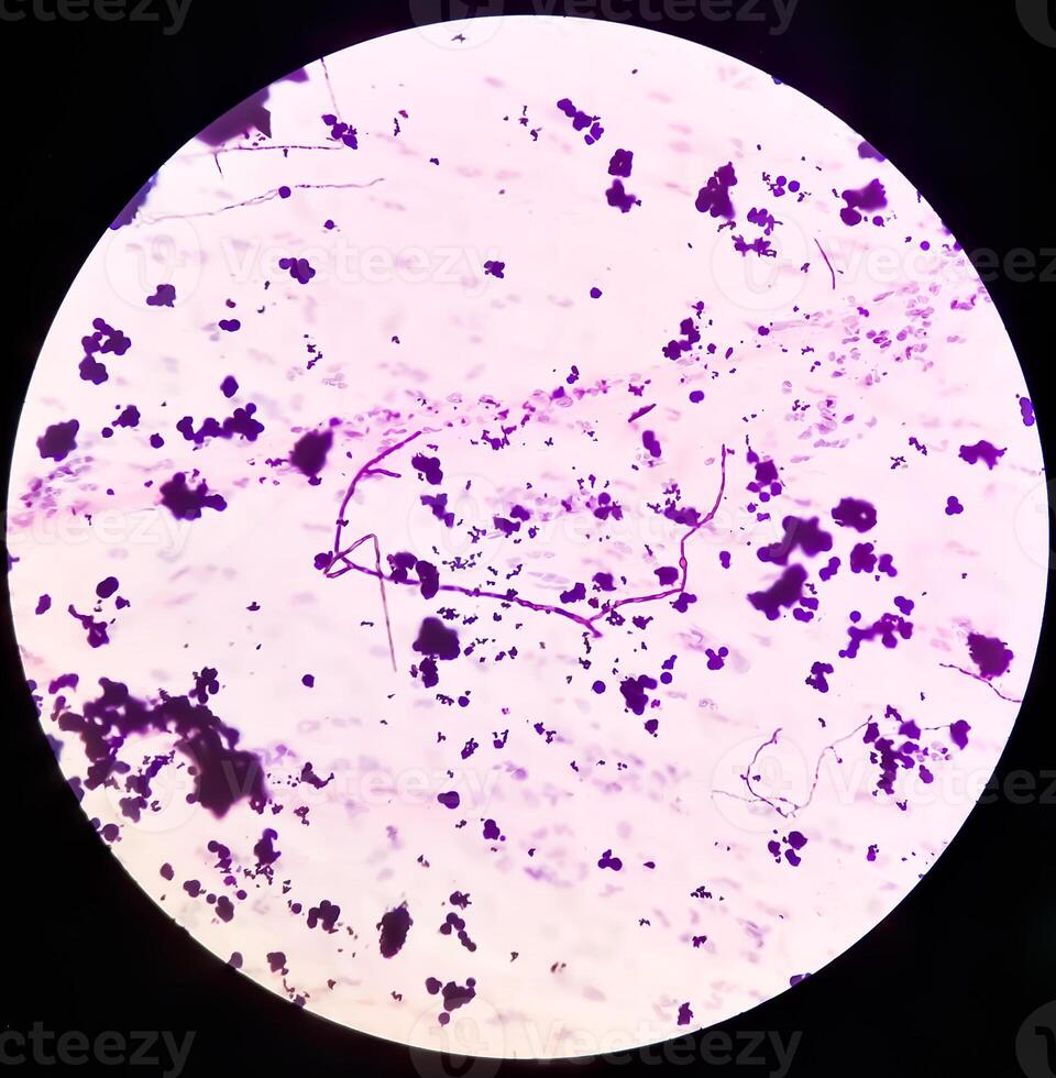 Photomicrograph of Paps Smear. Inflammatory smear with vaginal candidiasis . Medical concept. photo