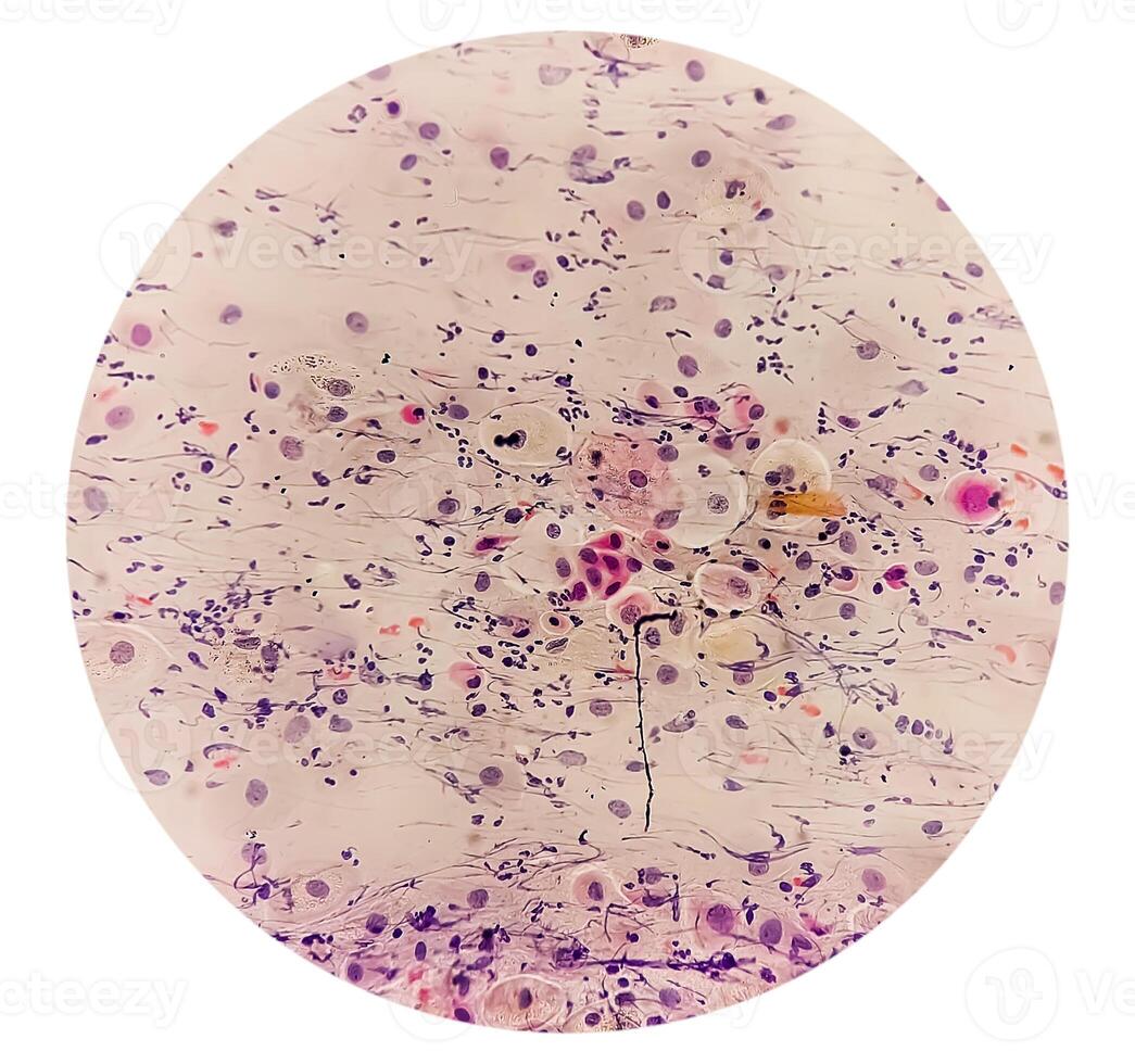 Photomicrograph of Paps Smear. Inflammatory smear with vaginal candidiasis . Medical concept photo